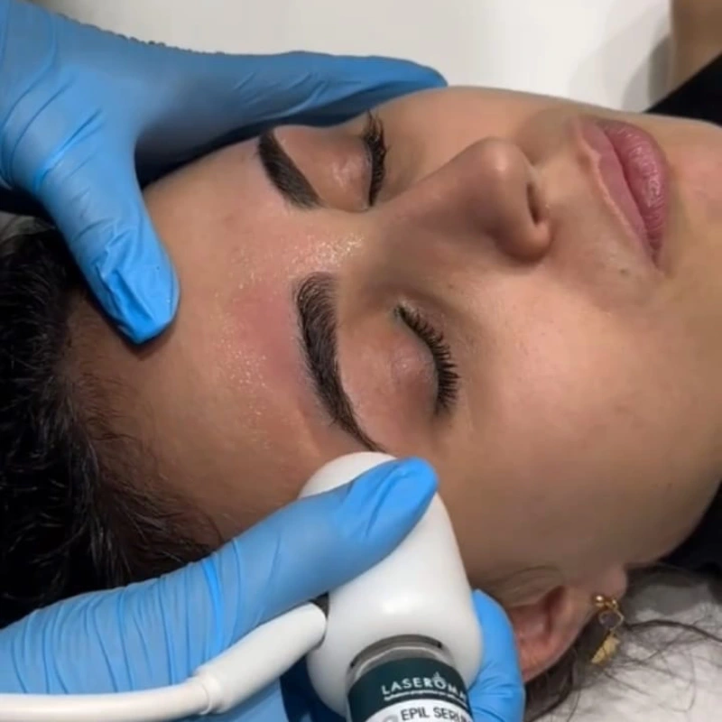 LASERoma Epilazione viso per pelli sensibili