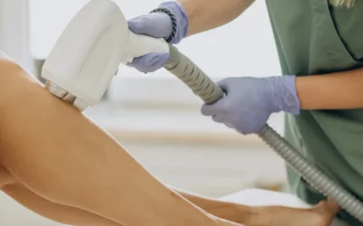 Epilazione Laser per Adolescenti: La Guida Completa per le Mamme